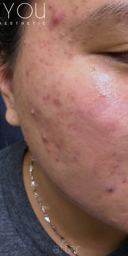 Microneedling Before & After Patient #343