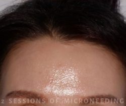 Microneedling Before & After Patient #344