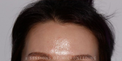 Microneedling Before & After Patient #344