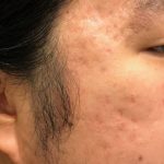 Microneedling Before & After Patient #345
