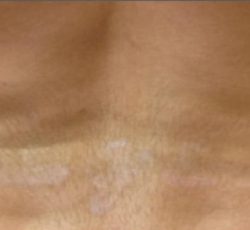 Picosure Before & After Patient #357