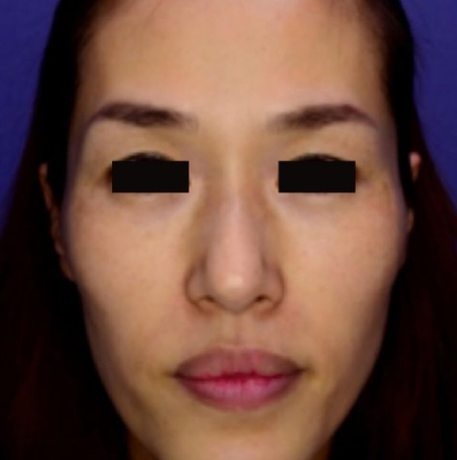 Picosure Before & After Patient #358