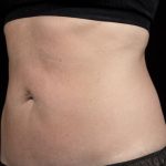 Sculpsure Before & After Patient #371