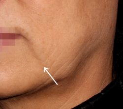 Juvederm Fillers Before & After Patient #270