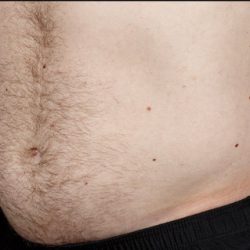 Sculpsure Before & After Patient #372