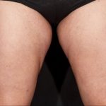 Sculpsure Before & After Patient #374