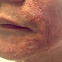 Juvederm Fillers Before & After Patient #271
