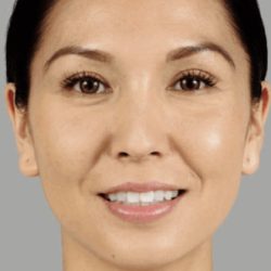 Juvederm Fillers Before & After Patient #272
