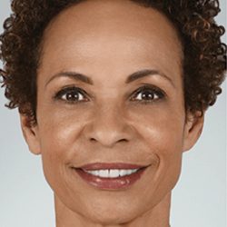 Juvederm Fillers Before & After Patient #274